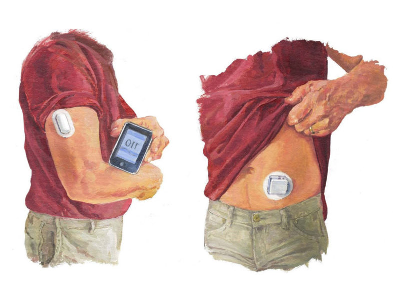An illustration of a man showing the location of a glucose monitoring device on both his right arm and his stomach